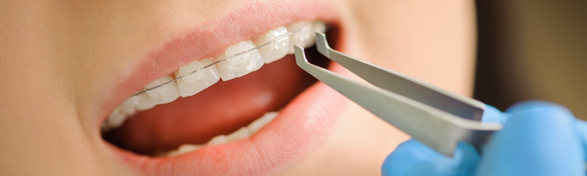 What Are Ceramic Braces