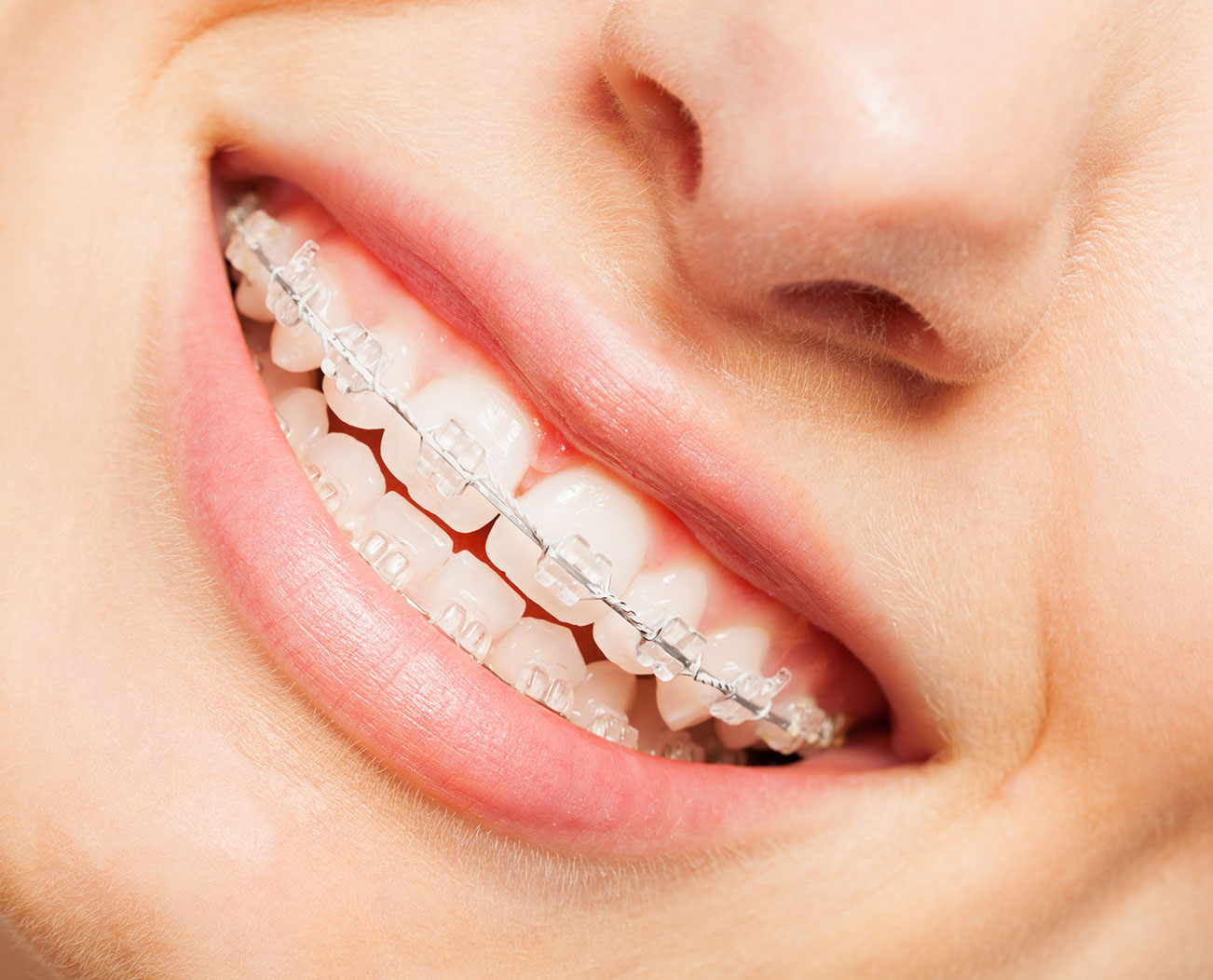 Mentor Invisalign